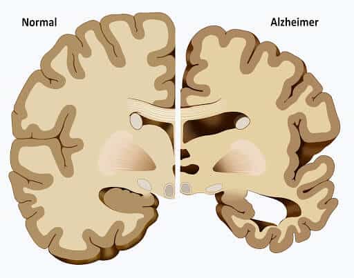 découvrez comment le cbd pourrait offrir de l'espoir pour améliorer la mémoire et soutenir les personnes atteintes d'alzheimer grâce à ses propriétés naturelles.